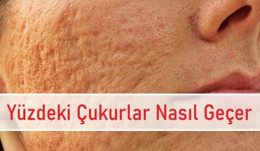Yüzdeki Çukurlar Nasıl Geçer Yüzdeki Çukurlar Nasıl Geçer