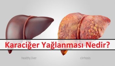 Karaciğer Yağlanması Nedir Karaciğer Yağlanması Nedir