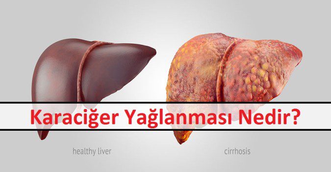 Karaciğer Yağlanması Nedir