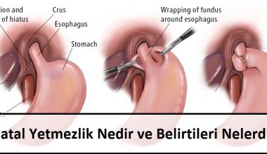 Hiatal Yetmezlik Nedir ve Belirtileri Nelerdir Hiatal Yetmezlik Nedir ve Belirtileri Nelerdir