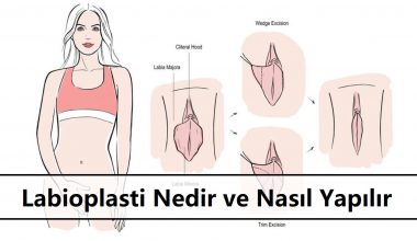 Labioplasti Nedir ve Nasıl Yapılır Labioplasti Nedir ve Nasıl Yapılır