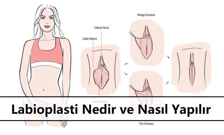 Labioplasti Nedir ve Nasıl Yapılır