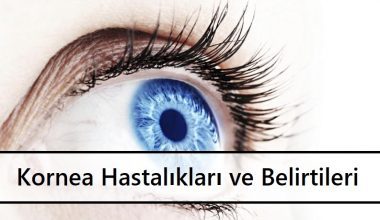 Kornea Hastalıkları ve Kornea Nakli Kornea Hastalıkları ve Kornea Nakli