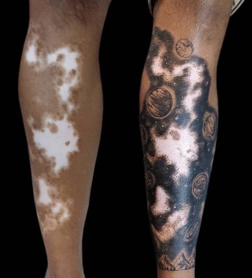 Vitiligo Hastalığı Galaksi Dövme Modeli