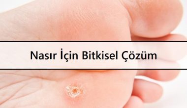 Nasır İçin Bitkisel Çözüm | Evde Doğal Tedavi Nasır İçin Bitkisel Çözüm | Evde Doğal Tedavi