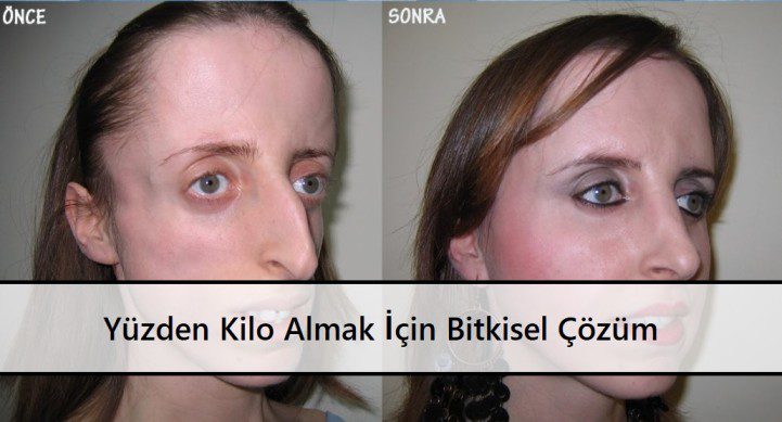 Yüzden Kilo Almak İçin Bitkisel Çözüm