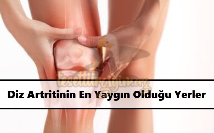 Diz Artritinin En Yaygın Olduğu Yerler