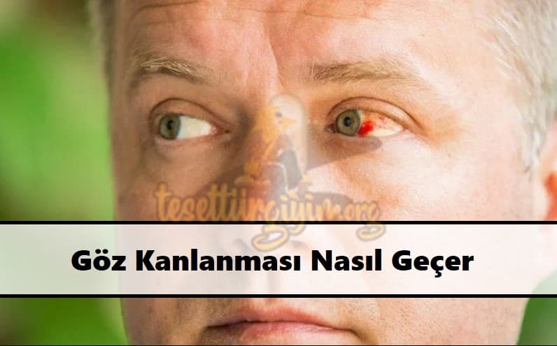 Göz Kanlanması Nasıl Geçer